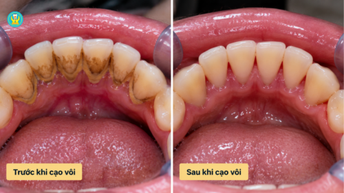 Răng cửa hàm dưới trước và sau khi cạo vôi răng tại Nha Khoa Sài Gòn