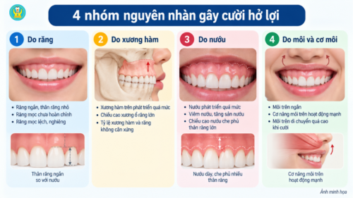 Bốn nhóm nguyên nhân gây cười hở lợi