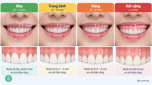 Các mức độ cười hở lợi theo tỷ lệ nướu lộ ra