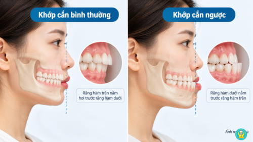 So sánh khớp cắn bình thường và khớp cắn ngược ở răng cửa